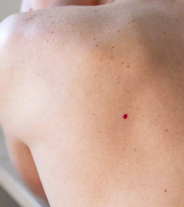 Signs Of Cherry Angioma