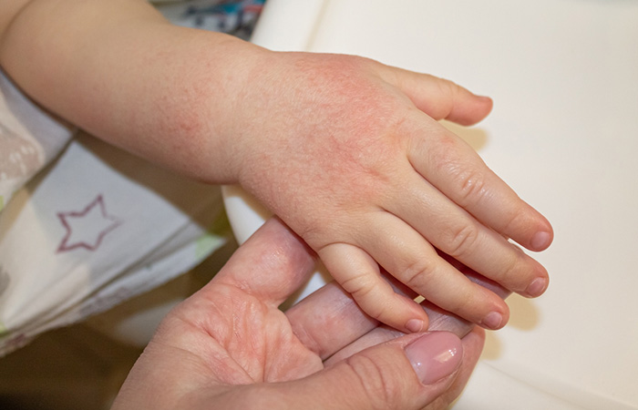 Skin redness on baby's hand can peel off the skin