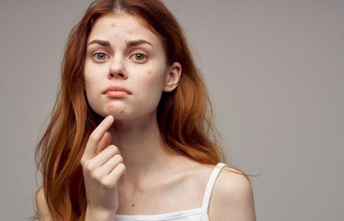Woman with acne may benefit from neroli essential oil