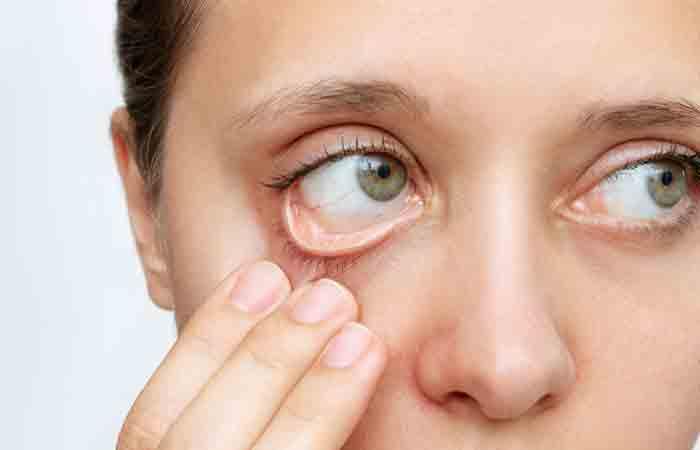 Anemic person with pale eyes may benefit from Turkey berry
