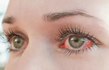 Eye irritation due to charcoal soap