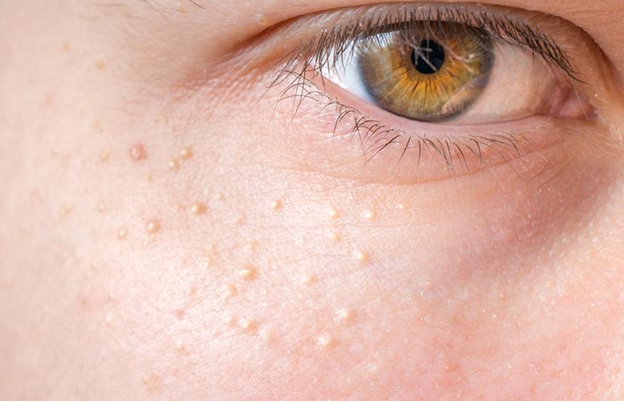 Breakouts after using almond oil for dark circles