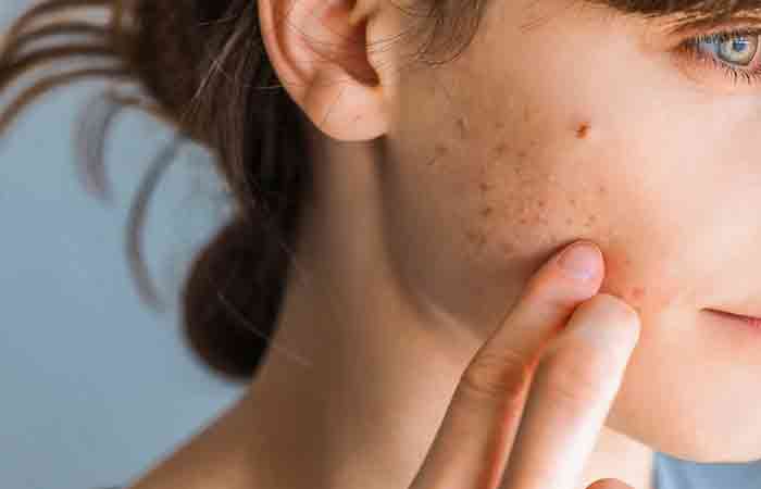 Continuously picking at skin can lead to lesions and marks