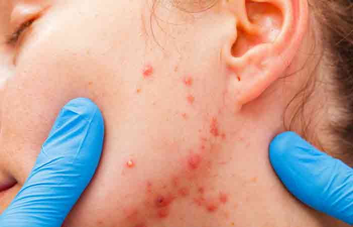 Skin picking may lead to infections that cause serious complications