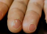 Fingertip Peeling: Causes, Remedies And Prevention