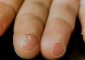 Fingertip Peeling: Causes, Remedies A...