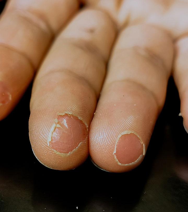 Fingertip Peeling: Causes, Remedies And Prevention