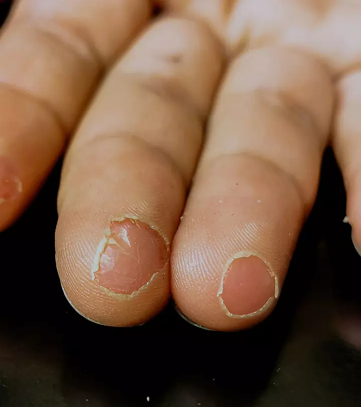What-Causes-Fingertip-Peeling-How-Do-You-Treat-It