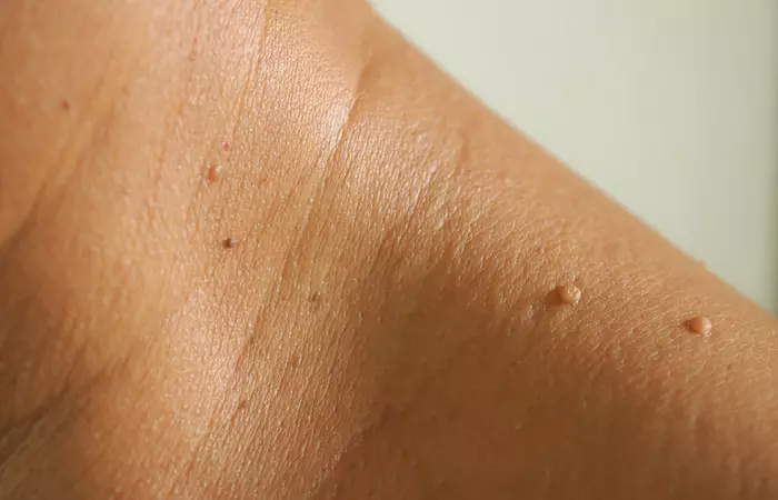 Skin Tags