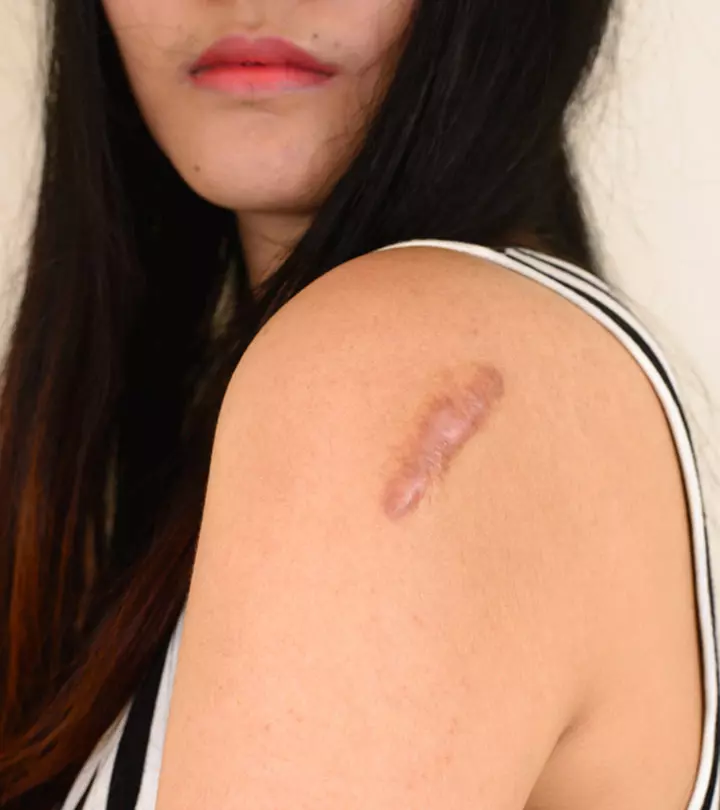 A Person Suffering From Vesicular Skin Lesions