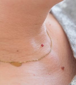 What Causes Skin Tags How Do You Remove Them