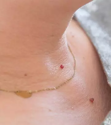What Causes Skin Tags How Do You Remove Them