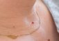Skin Tags: Causes, Appearance, And Re...