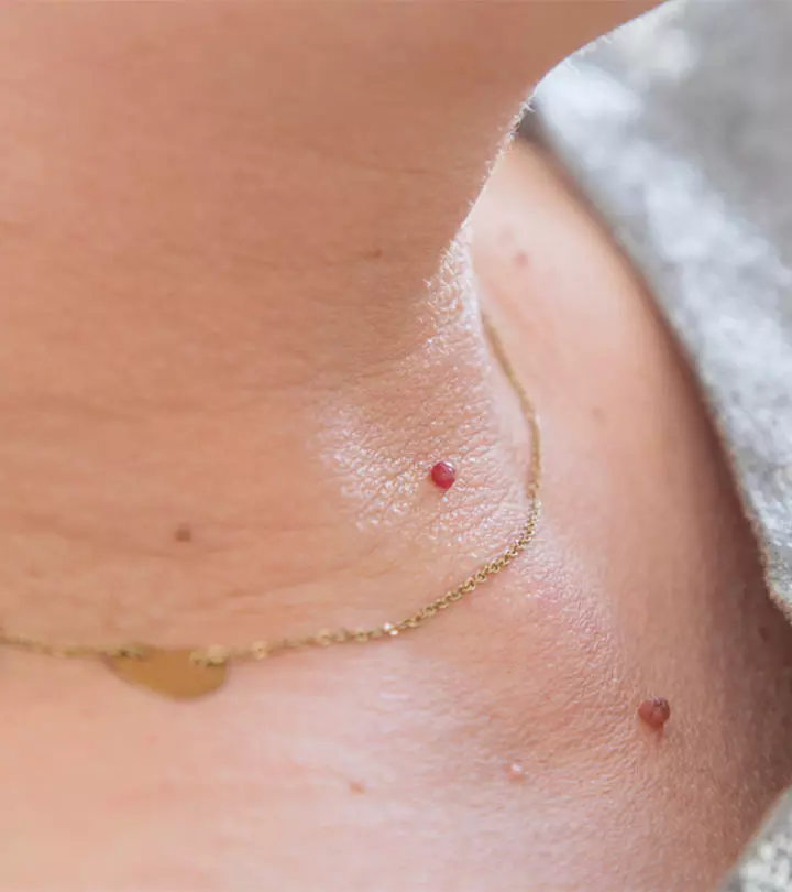 Close-up Of Skin Tags On A Person's Neck