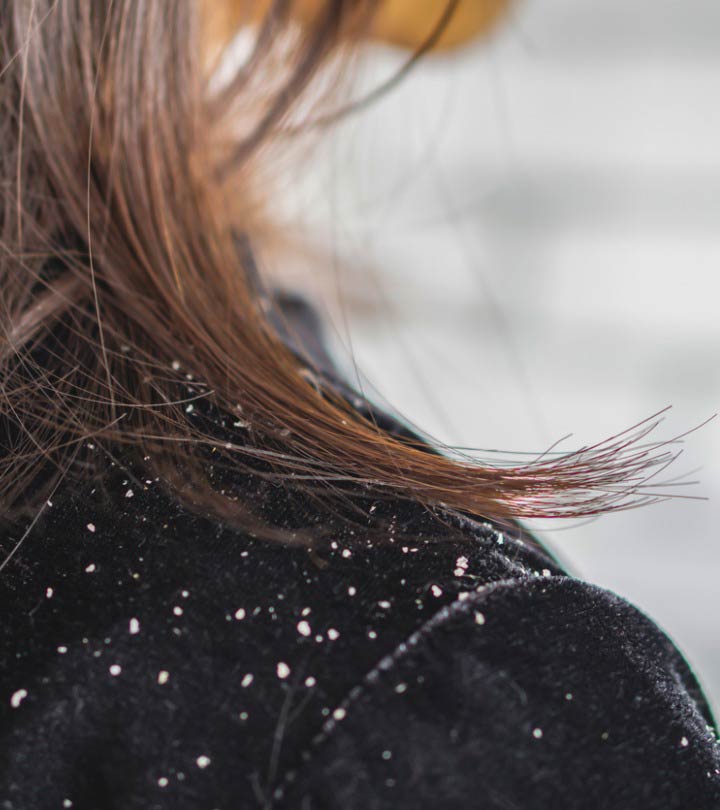 7 Things Everyone Gets Wrong About Dandruff