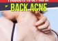 9 Best Products To Get Rid Of Back Acne E...