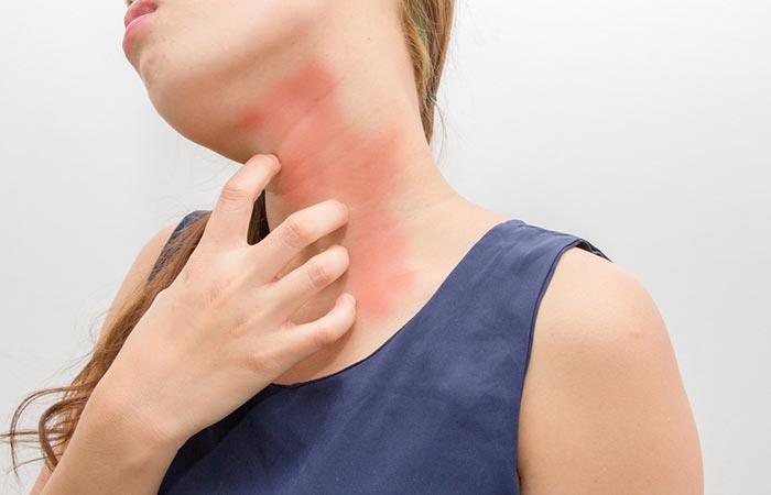 Woman with allergic rashes on the neck due to falafel