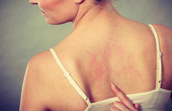 Redness as a symptom of itching