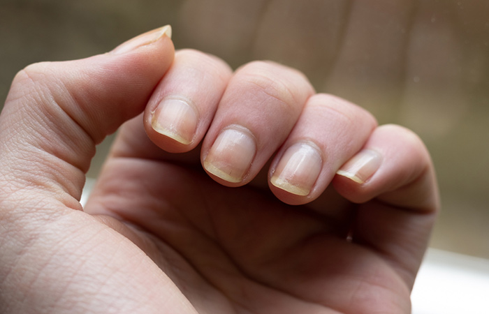 Allergic reaction to nail products can result in discolored nails