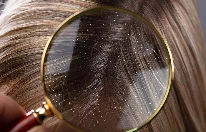 Dandruff