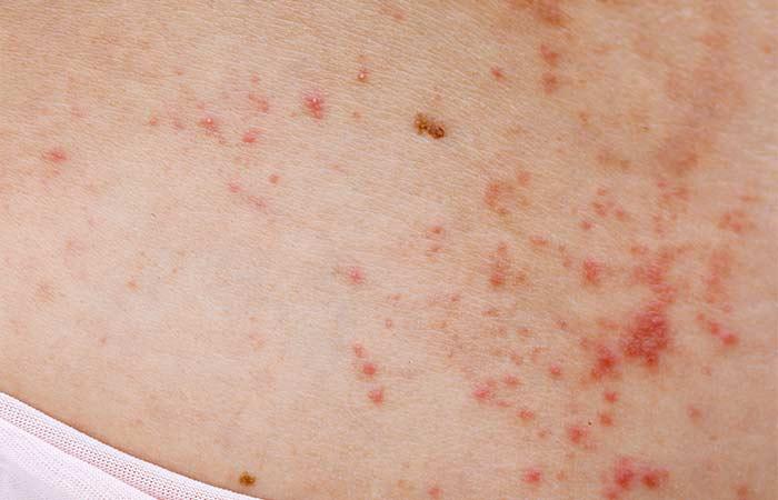 Heat Rash In Adults Causes Treatment And Prevention Tips