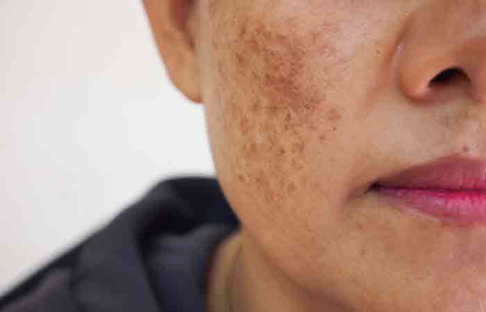 Woman with hyperpigmentation may benefit from winter melon