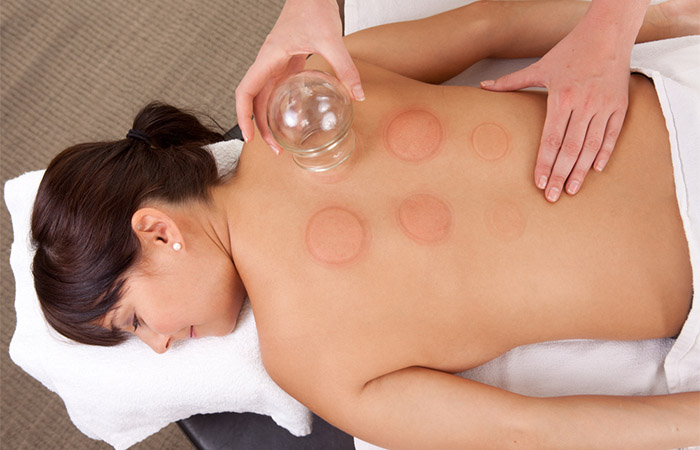 Cupping therapy may cause bruises.