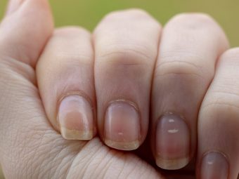 What Are White Spots On Nails And How To Get Rid Of Them