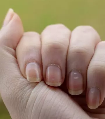 What Are White Spots On Nails And How To Get Rid Of Them