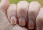 White Spots On Nails: What Are They A...