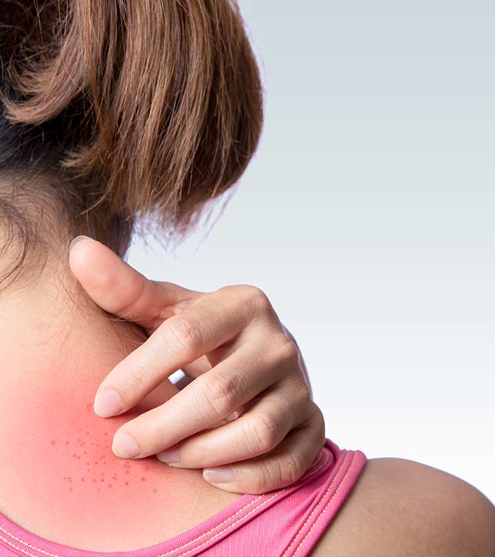 Heat Rash In Adults: Causes, Treatment, And Prevention Tips
