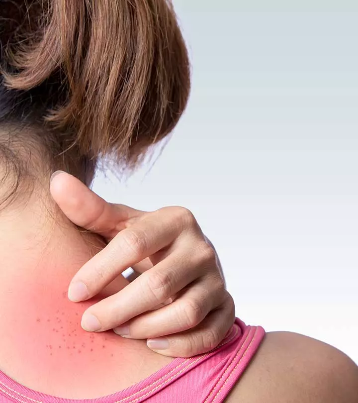 A girl scratching her back shoulder heat rash