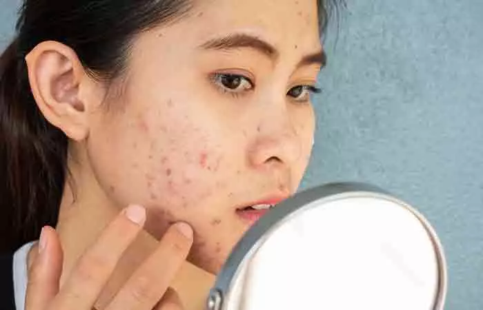 People with acne may be at risk for hidradenitis suppurativa