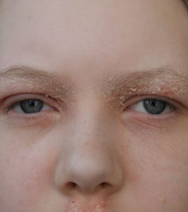 Dry Eyelids: Causes, Symptoms, And Tr...