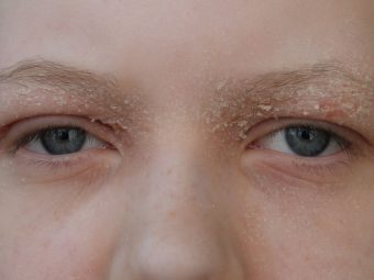 Why Do You Get Dry Eyelids? How To Treat Them?