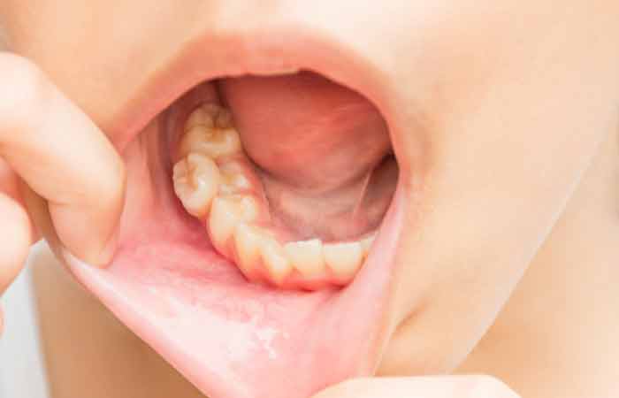 Your-Teeth-May-Become-More-Sensitive