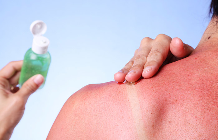Woman applying aloe vera gel on sunburnt skin