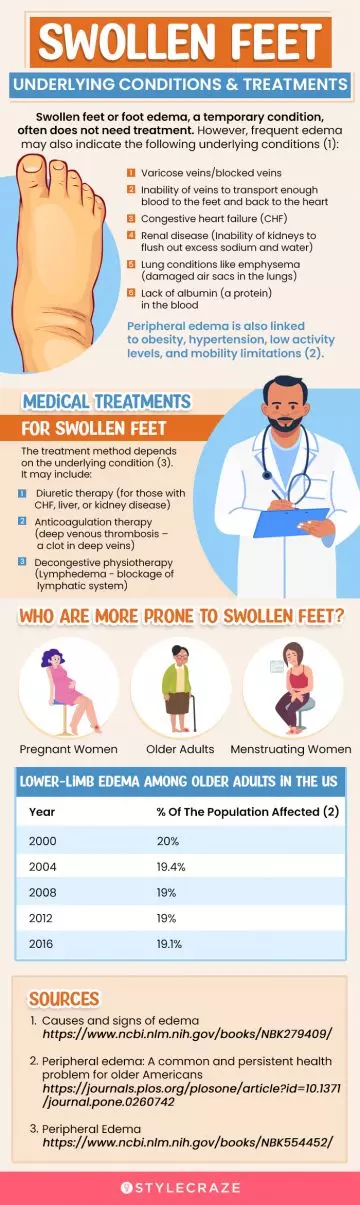 facts about swollen feet (infographic)