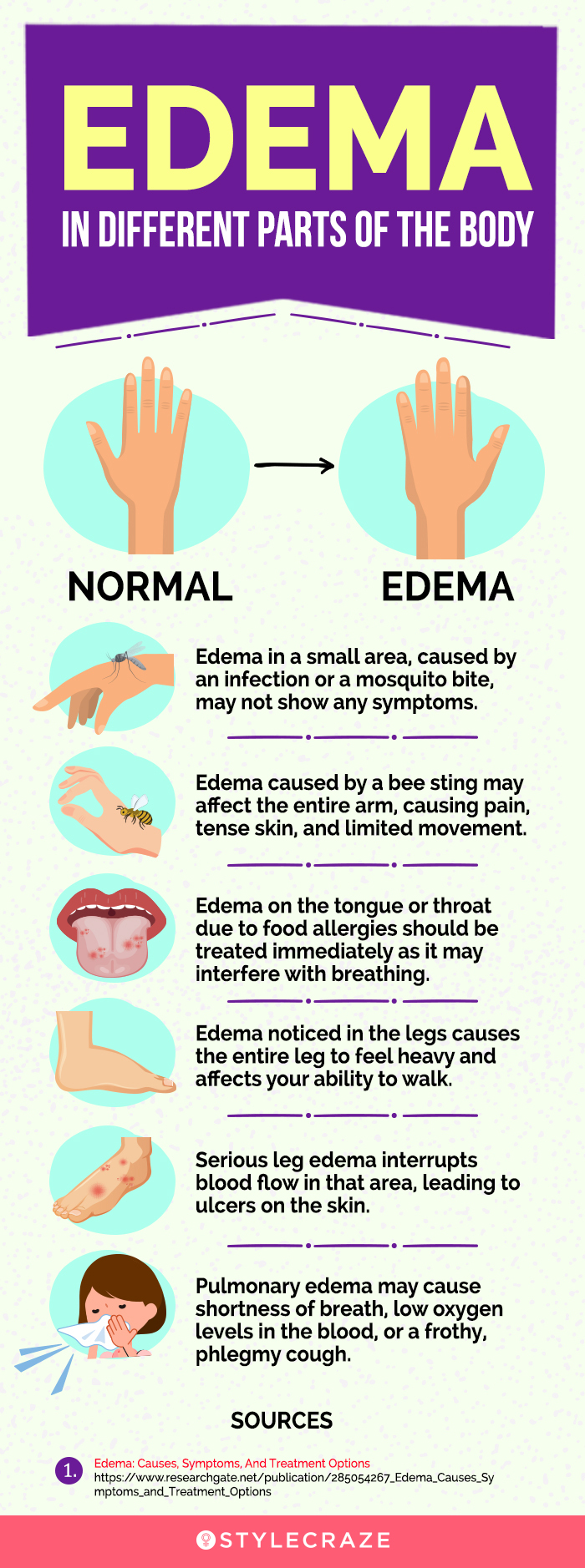 edema in different parts of the body (infographic)