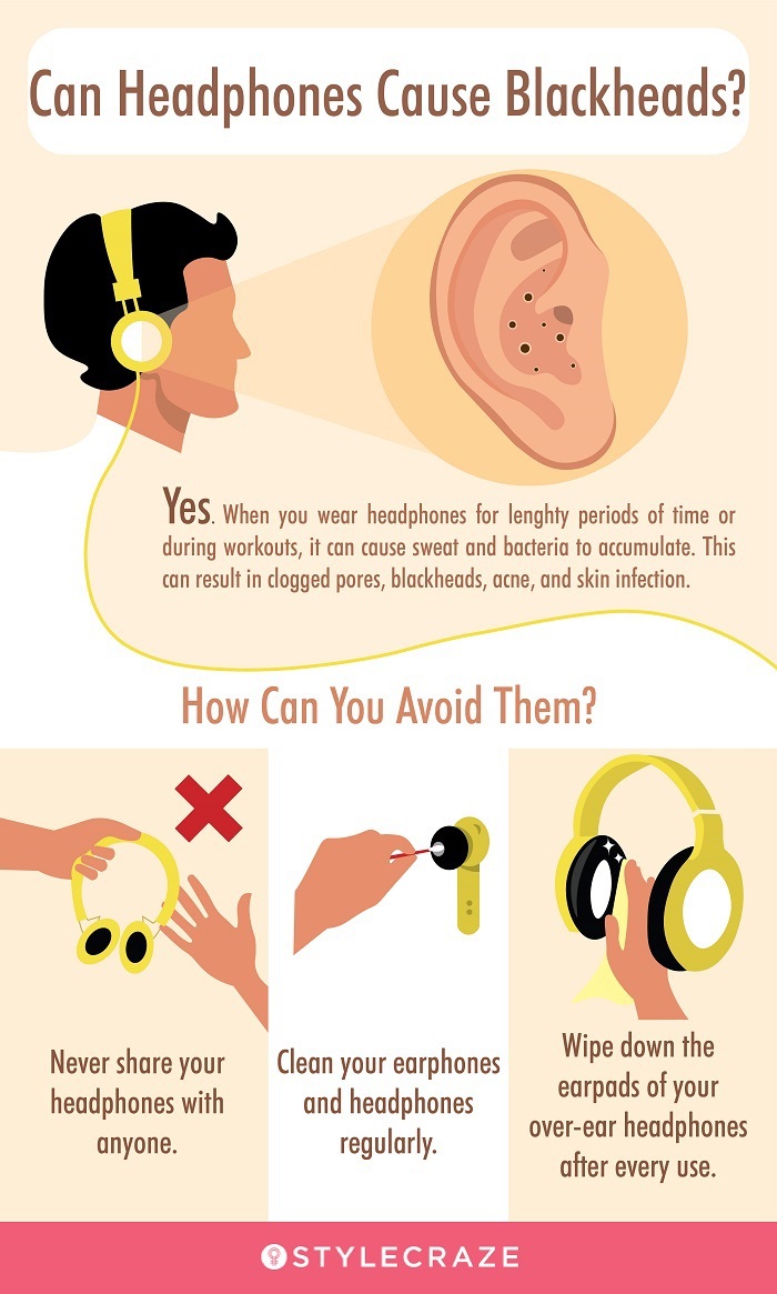 can headphones cause blackheads (infographic) 
