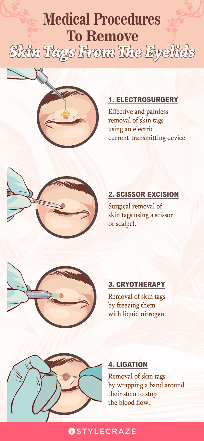 medical procedures to remove skin tags from the eyelids (infographic)