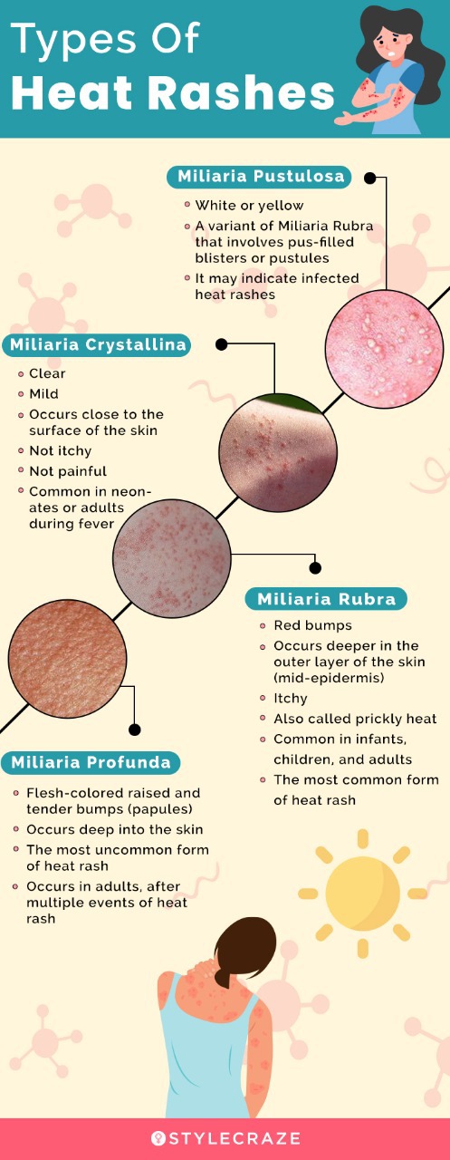 types of heat rashes (infographic)