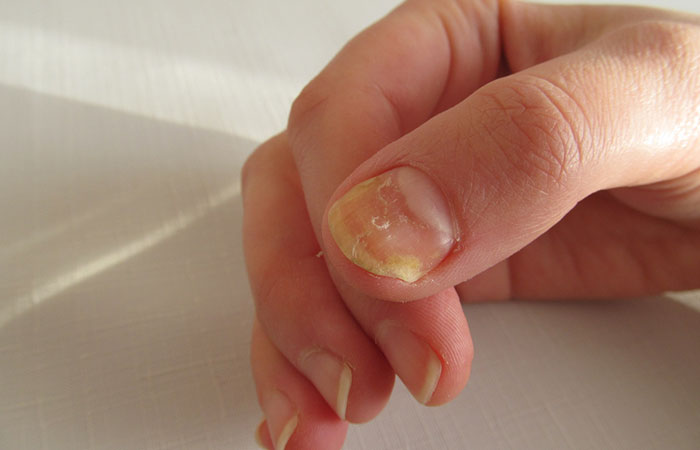A person with nail ailments