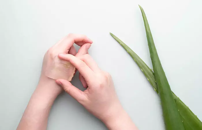 A woman is applying aloe vera on the affected areas