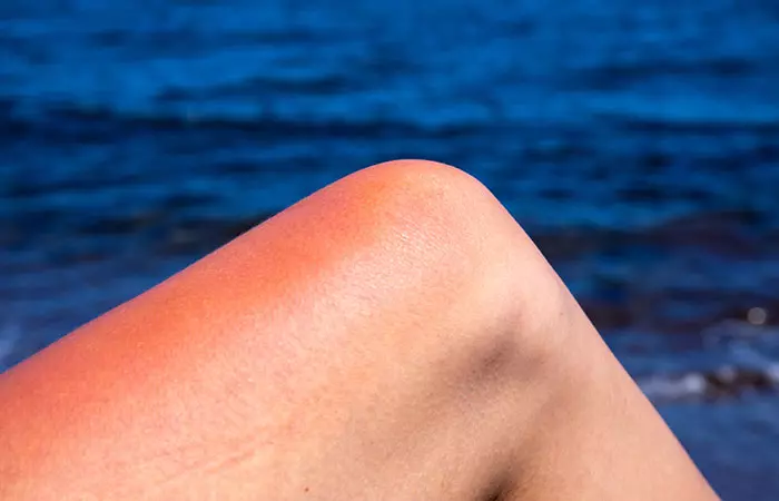 A woman with redness and skin irritation due to the sun