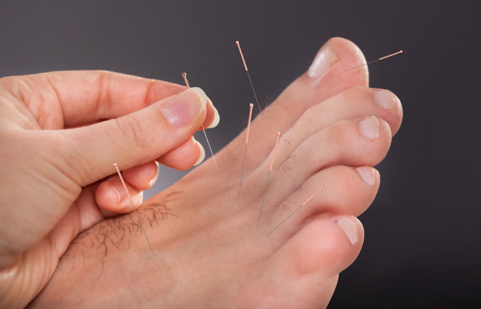 Acupuncture for hair growth