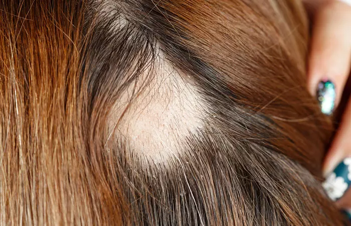 Bald patches may become very visible due to trichotillomania