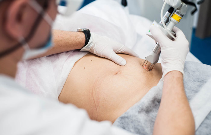 Close up of a doctor performing laser therapy on stretch marks