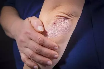 Close up of a woman experiencing psoriasis.