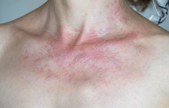 Close up of a woman's sunburned chest